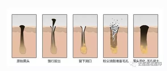 其实就跟祛痘痘一样,黑头的去除就是溶解掉堵塞在毛孔内的角栓,可以