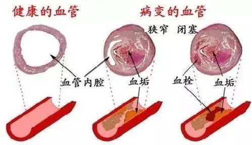 喝啤酒肩膀酸痛怎么办