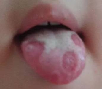 母婴 正文  这样的舌苔往往伴有口腔内有酸腐的味道,这是宝宝油腻的
