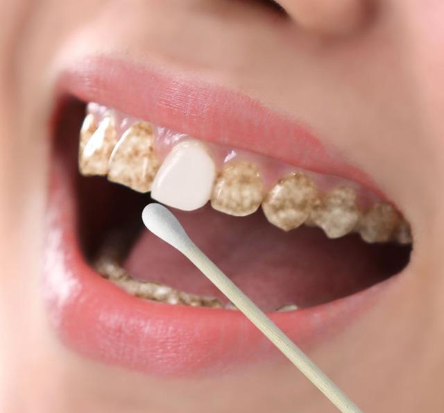 氟斑牙又称氟牙症,是牙齿发育矿化时期机体摄