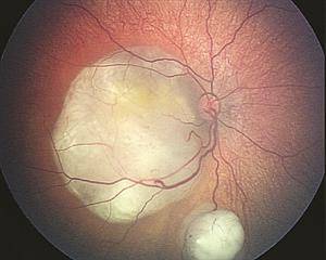 视网膜细胞瘤