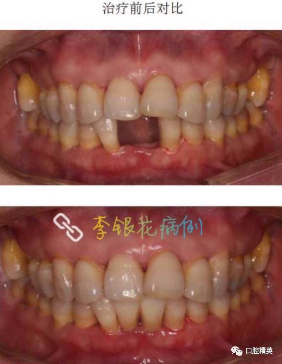 牙周病牙齿缺失修复这种修复可能更合适