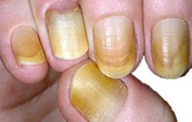 5,凹凸不平的横纹:指甲营养不良
