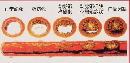 喝啤酒肩膀酸痛怎么办