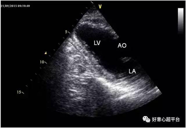超声微课堂胸骨旁心尖切面