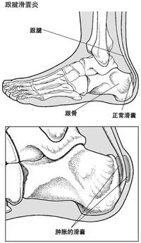 跑步后脚跟疼痛是怎么回事