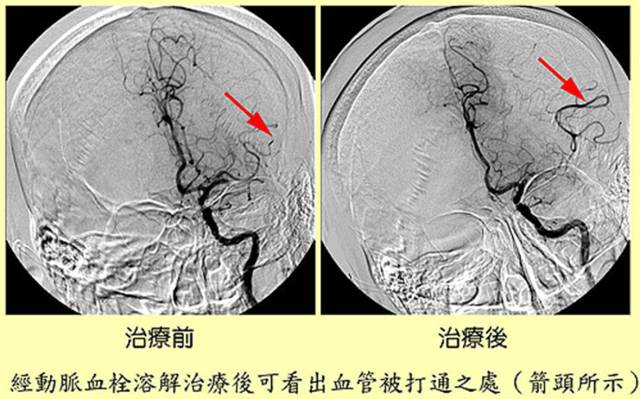 喝啤酒肩膀酸痛怎么办