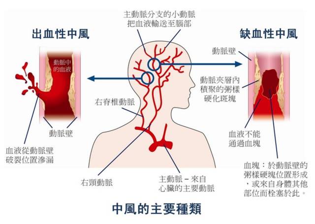 喝啤酒肩膀酸痛怎么办