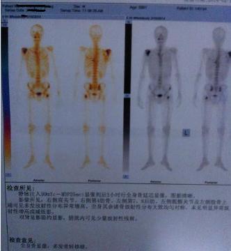 35岁哥哥肺癌后,我决定陪他战斗到底,不到最后决不放弃!