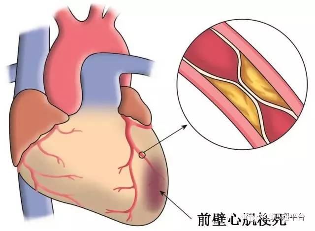 左前降支分支冠脉闭塞导致前壁心肌梗死示意图