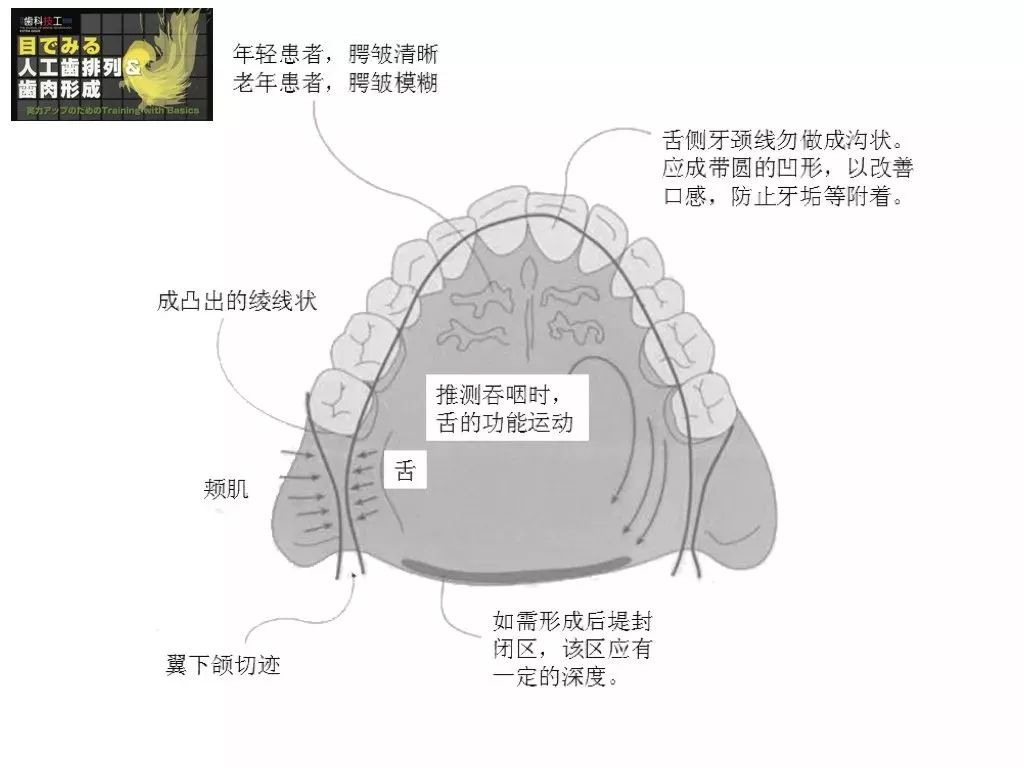 在制作光滑面时,应充分考虑舌体的感受,在上腭与下颌舌侧,做出与舌