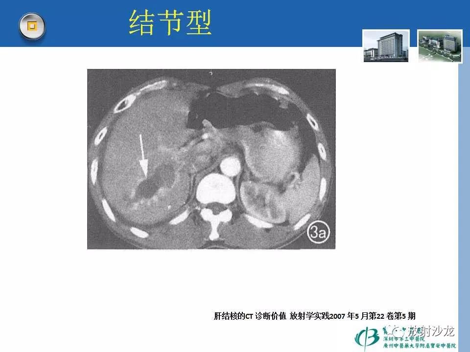 每日一例480例右胁肋部疼痛一周肝内占位3天