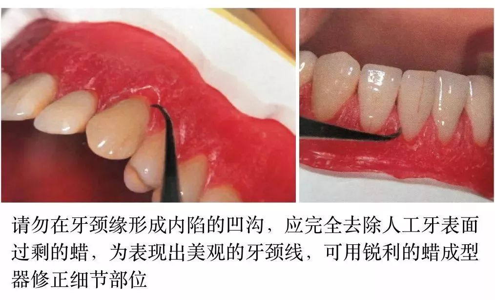 胡常红:全口义齿光滑面成型(本科技术班课程系列)