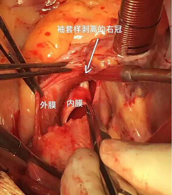 次全弓替换 右冠状动脉搭桥手术