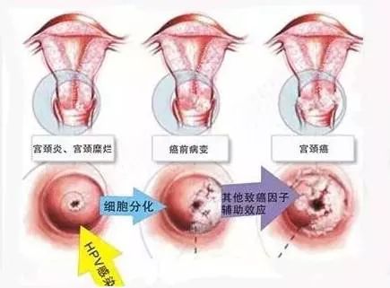 健康 正文  宫颈癌是女性最常见的恶性肿瘤,其死亡率仅次于乳腺癌.