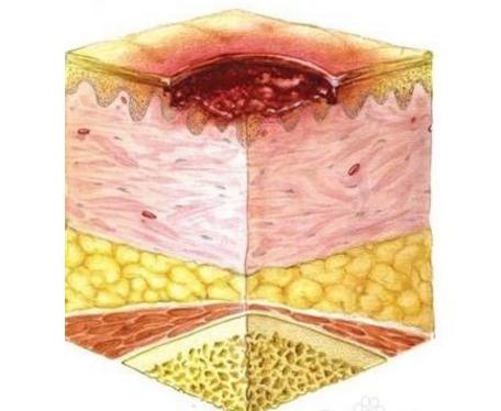 连续3天,使表皮形成一层较厚的保护层,以增加皮肤的抵抗力,对预防褥疮