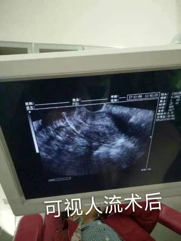 在做无痛人流手术前,必须要经过医生检查,以确定是宫内怀孕 2.