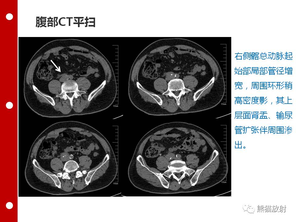 petct病案讨论腹膜后纤维化影像学特点ctmri