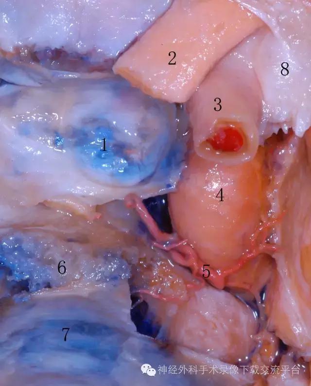 2 视神经 3颈内动脉床突上段 4颈内动脉海绵窦段5 脑膜垂体干 6鞍背