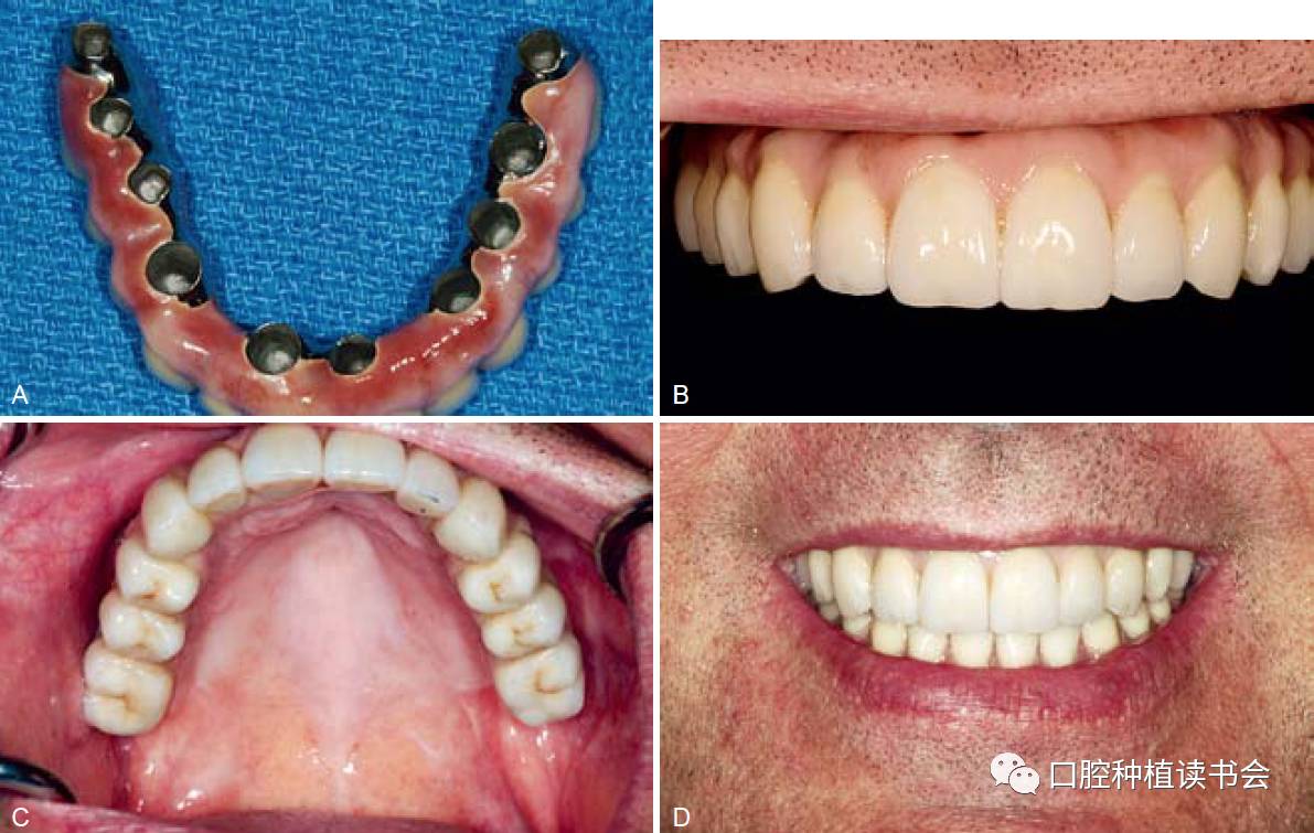 上颌无牙颌种植固定修复方案