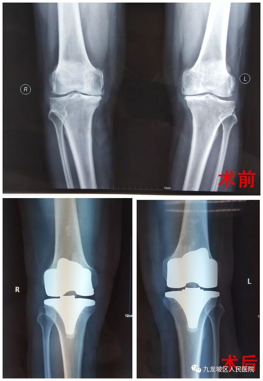 【院动态】我院西院骨科完成首例双侧膝关节置换术