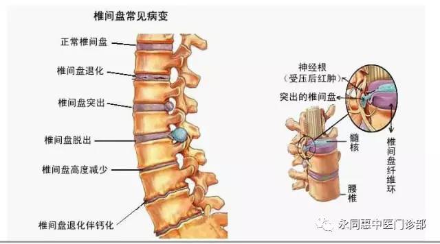 中医治疗腰椎病的原理是什么_幸福是什么图片