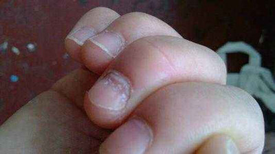 有小凹陷 原因:湿疹 办法:如果宝宝指甲有小凹窝,而且指甲比较薄还