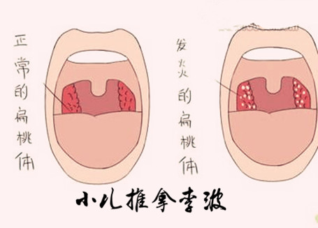 免疫功能开始发生作用,这个时期要注意提高宝宝的体质,预防扁桃体发炎