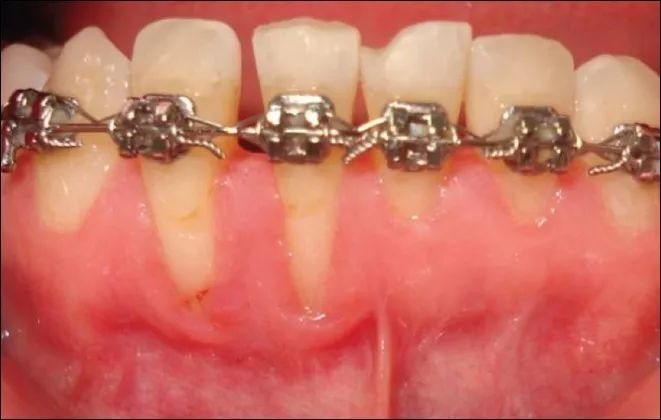 矫治后的患牙易因支持组织不足而再次移位,导致正畸治疗的失败
