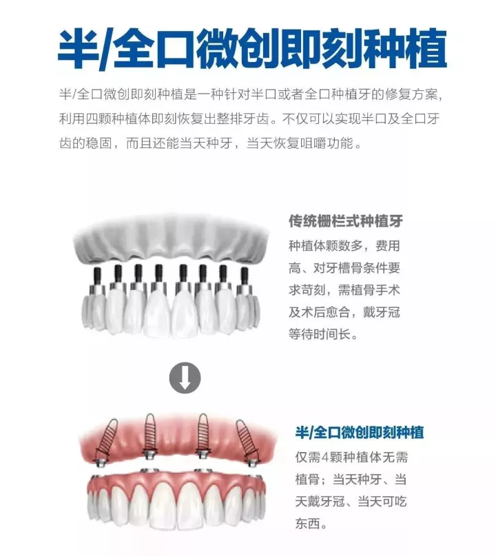 宝威体育下载网站：种植牙你知道吗？