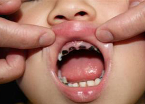 儿童期龋齿容易导致牙颌面畸形,专家提醒切勿忽视