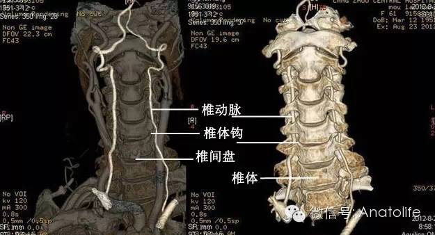 颈椎cta,显示椎体排列关系和椎动脉穿行于横突孔mr:正常颈椎部分的矢