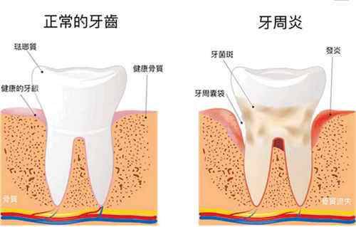 损伤一:牙周病