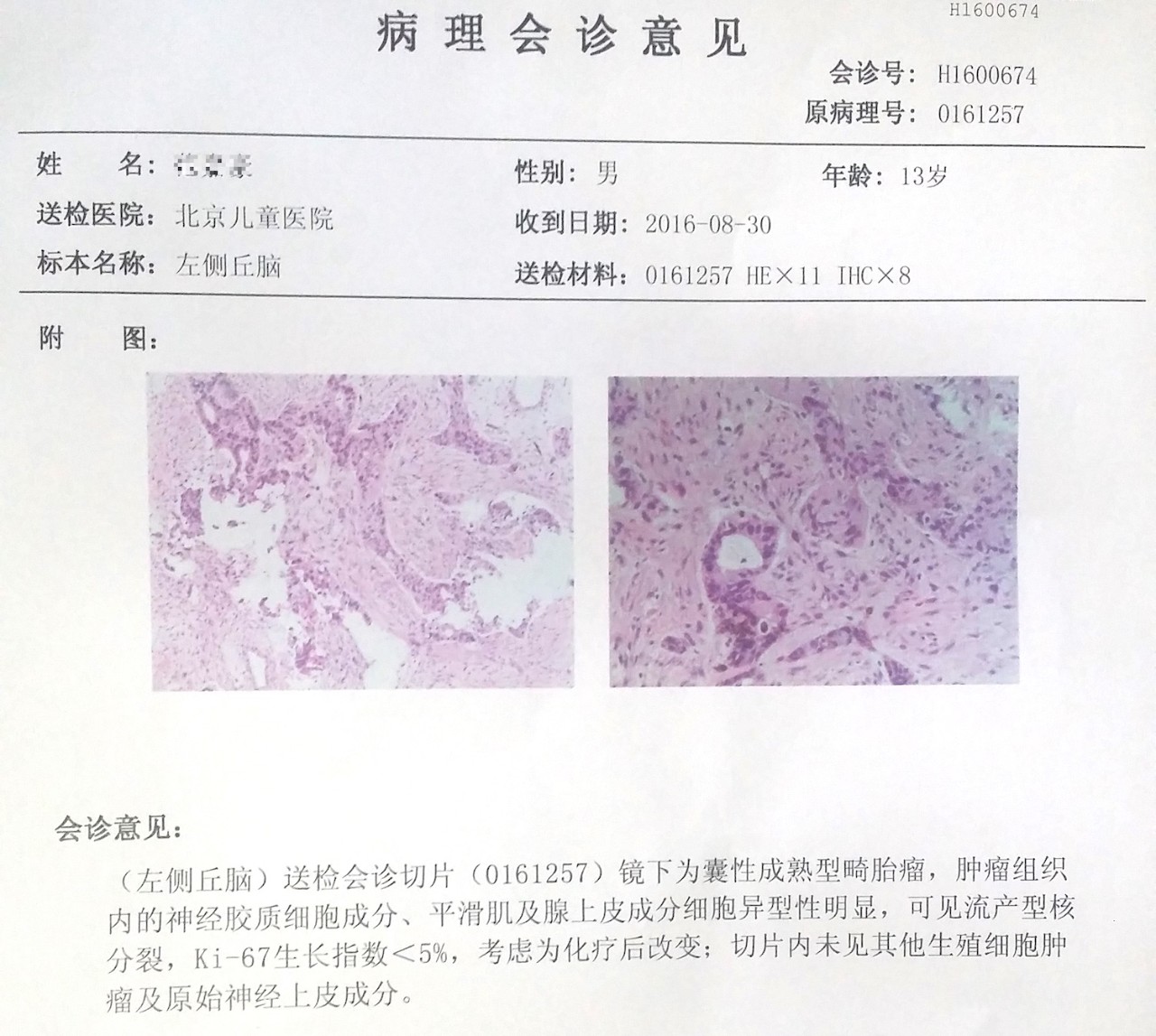 [徕卡神刀博览]儿童左额脑室造瘘左侧丘脑肿瘤全切除术一例-北京儿童