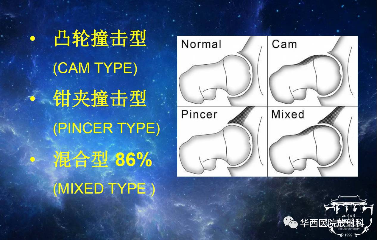 内旋为著,体育活动或者长时间行走后加重;有时疼痛会向外放射到大转子