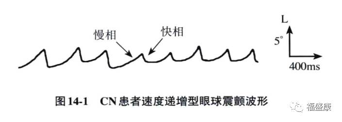 专业先天性眼球震颤的分类