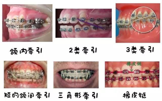 这些图案代表的是不同大小粗细,也就是能产生不同力值的橡皮圈种类的