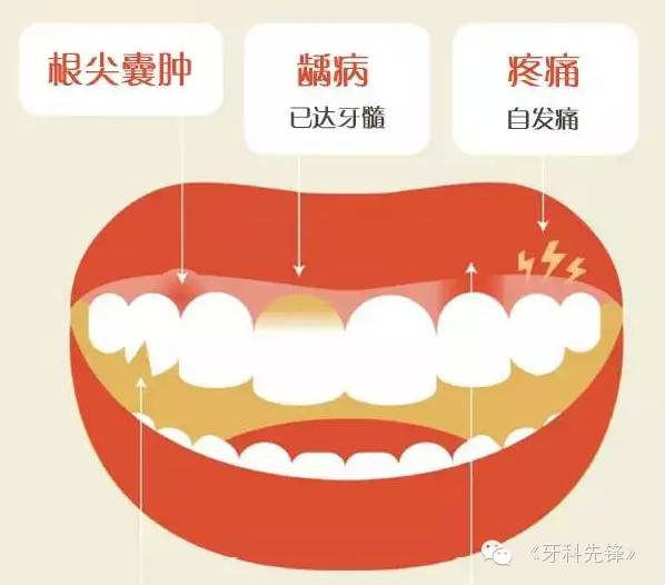 图解根管治疗专治牙齿内心疾病