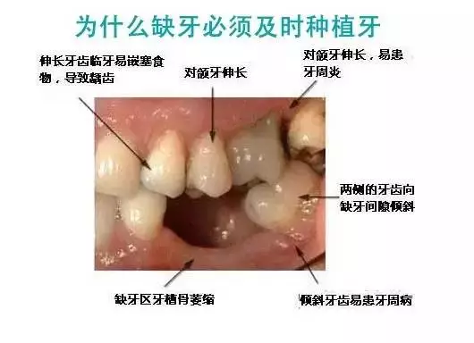 假牙搭不上怎么办_假牙套在真牙上图片(2)