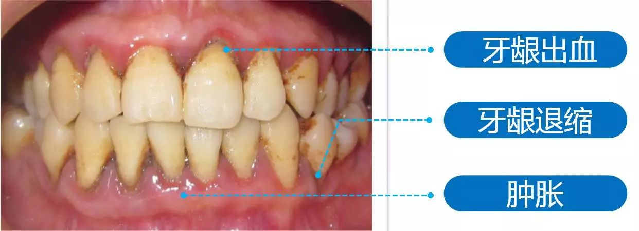 牙龈出血,肿胀,牙龈退缩,其实这些也就是我们常说的牙周病的一系列