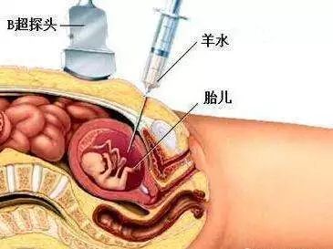 羊膜腔穿刺必须做吗?其实,产科医生一直都是这么说的