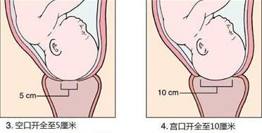 宫口开十指就代表要生,有多少人认为十指就是十个手指?