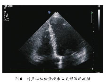 前降支心肌桥疑致急性心肌梗死一例