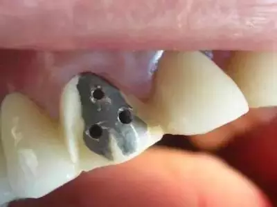 把你的牙齿都磨得像老鼠牙,锥形牙,甚至牙髓外露,还要做根管,疼啊!