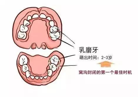 一是 2-3岁时,乳磨牙萌出后,可以进行窝沟封闭