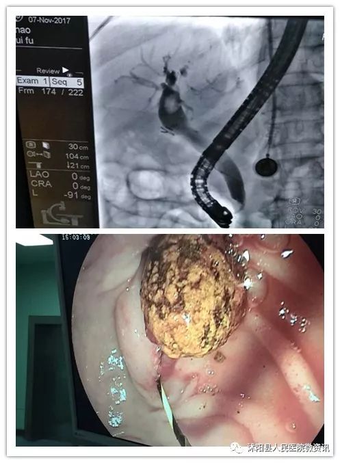 【沭医之声】高龄老人胆总管结石经内镜ercp成功取石