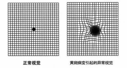 老年黄斑变性自测,向眼底病说"不"!