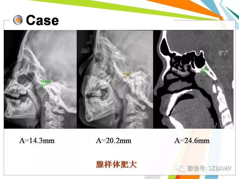 儿童不可不注意的问题,腺样体肥大的检查及影像