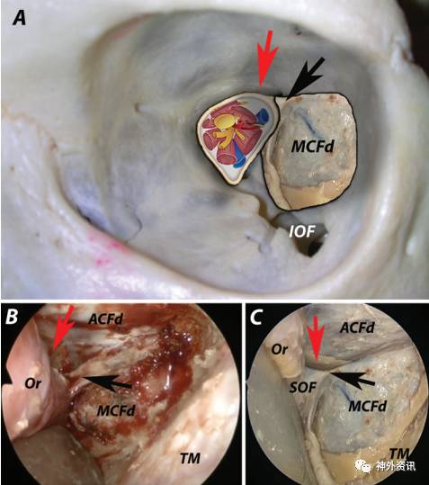 注意保护眶上裂(superior orbital fissure,sof),从硬膜间进入海绵窦