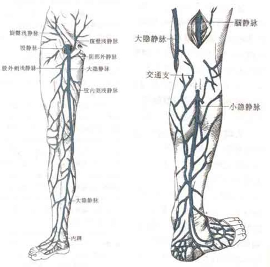 把握住下肢静脉曲张的治疗时机